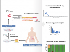 世界首例！我国学者利用干细胞成功治疗1型糖尿病 开辟医疗新纪元